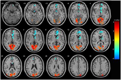 Abnormal brain spontaneous activity in major depressive disorder adolescents with non-suicidal self injury and its changes after sertraline therapy